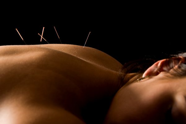 Treatment Review Acupuncture
